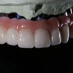 Implant Ninja Dental Center - Ceramic overlay of the implant bridge creates a highly cosmetically appealing outcome.