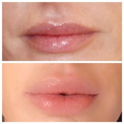 The Laser Spa at Sonoma - Before & After 2 syringes of Restylane Refyne (Dermal Filler).