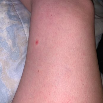 Wickford Motor Inn - Bedbug bites - Hotels Near Me - North Kingstown, Rhode Island Wickford Motor Inn - Bedbug bites - Hotels Near Me - North Kingstown, Rhode Island
