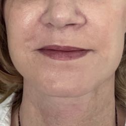 Sanaz Harirchian, MD - 3 week post-op
