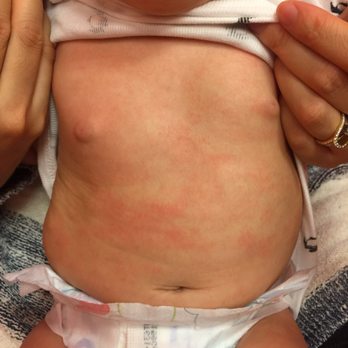Rapha Acupuncture and Herbs - This is my baby's eczema - Acupuncture Near Me - Arcadia, California Rapha Acupuncture and Herbs - This is my baby's eczema - Acupuncture Near Me - Arcadia, California