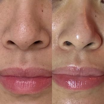 Radiance Skincare - After extraction - Skin Care Near Me - Tustin, California Radiance Skincare - After extraction - Skin Care Near Me - Tustin, California