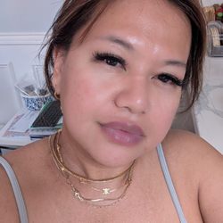 Osita Health Clinic - Post filler treatment ( naso-labial,  marionette, chin, cheeks,jaw,chin) prev treated w Jeuveau on the forehead, 11s, nasal flaring, DAOs
