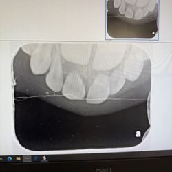 Ten Tigers - My 5 year olds 2 front teeth knocked loose and fell out. Lincoln's reckless "teaching" style.