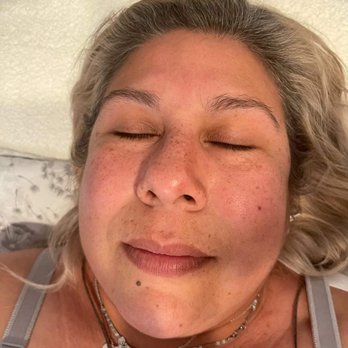 The Spa At Canyon Crest - This is my Before photo of deep pore facial. - Day Spas Near Me - Riverside, California