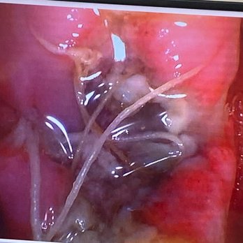 Raina Dental Care - Photo of Raina's brilliant extraction work :) - Oral Surgeons Near Me - Naperville, Illinois