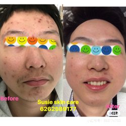 Susie Skin Care Clinic - Stop acne and remove scar
