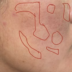 Forever Young Laser & Skin Center - Lousy laser treatment that does not cover majority of my cheek