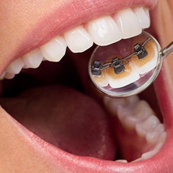 Kwon Orthodontics - Lingual Braces - Orthodontists Near Me - La Canada, California Kwon Orthodontics - Lingual Braces - Orthodontists Near Me - La Canada, California