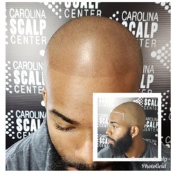 Carolina Scalp Center/Scalp Micropigmentation - Scalp Micropigmentation gave this young man his youthful appearance back.
