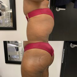 Glowism Aesthetics - Results from 1 session of the Derrière Butt Lift. We recommend multiple sessions.
