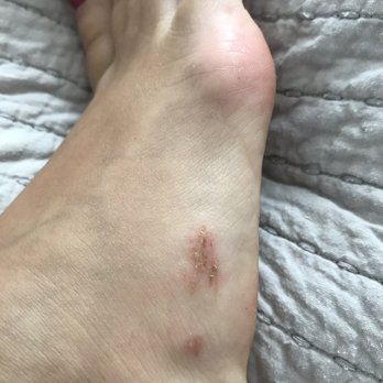 Nail looks - This is what the scratch looks like the next day. - Day Spas Near Me - Kenneth City, Florida Nail looks - This is what the scratch looks like the next day. - Day Spas Near Me - Kenneth City, Florida