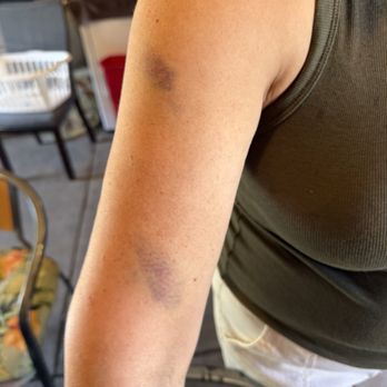 Abiel Limo - Bruises from the door hitting her and her fall - Airport Shuttles Near Me Abiel Limo - Bruises from the door hitting her and her fall - Airport Shuttles Near Me