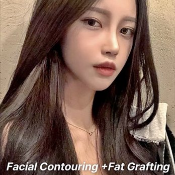 Renew Beauty - Face contour with HA fillers - Estheticians Near Me - Riverside , California Renew Beauty - Face contour with HA fillers - Estheticians Near Me - Riverside , California