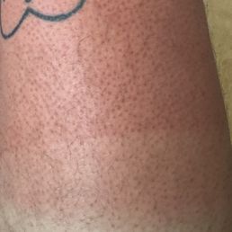 2nd degree burns due to camping outside for a week all to be turned away 10 spots before my turn 2nd degree burns due to camping outside for a week all to be turned away 10 spots before my turn