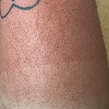 Swatch - 2nd degree burns due to camping outside for a week all to be turned away 10 spots before my turn - Accessories Near Me - Miami Beach, Florida
