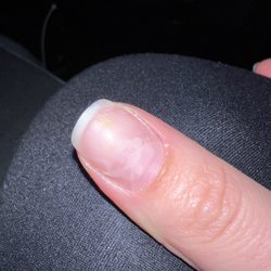 Vi Nails - More fungus