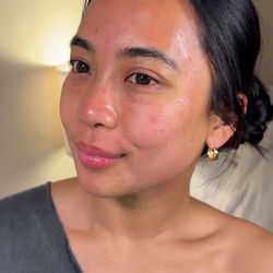 Post Microneedling + EZGEL undereye