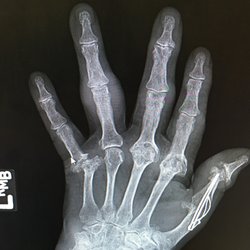 Jon Norberg, MD - Rheumatoid Arthritis Hand and Wrist