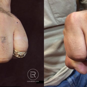 Renewal Laser Rochester - Laser tattoo removal done by Renewal Laser. #tattooremoval #rochestermn #tattooremovalmn #renewallaser #reclaimyourcanvas #besttattooremoval - Tattoo Removal Near Me - Rochester, Minnesota Renewal Laser Rochester - Laser tattoo removal done by Renewal Laser. #tattooremoval #rochestermn #tattooremovalmn #renewallaser #reclaimyourcanvas #besttattooremoval - Tattoo Removal Near Me - Rochester, Minnesota