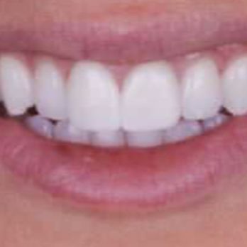 Thomas Nabors,DDS - Before - I had two oversized/discolored veneers on my front teeth. - Cosmetic Dentists Near Me - Nashville, Tennessee