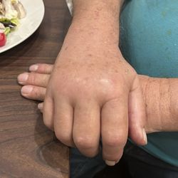 Brandon Cincere, MD - Fourth photo right hand, post-op