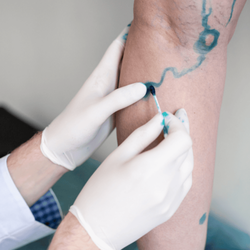 USA Vein Clinics - Vein mapping