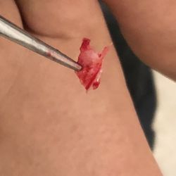 Ingrown toenail