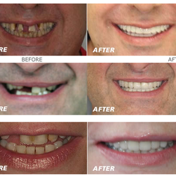 Carrollton Advanced Family Dentistry - Before and after photos done by Dr. Markose, DDS, MSD Prosthodontist