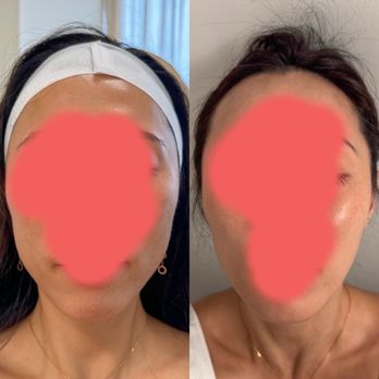 Nudeskin - Masseter Botox - Laser Hair Removal Near Me - Arlington, Virginia Nudeskin - Masseter Botox - Laser Hair Removal Near Me - Arlington, Virginia