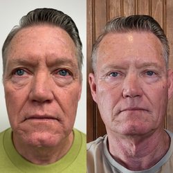 Hey Sister Spa - Before & After male facial rejuvenation - Radiesse
