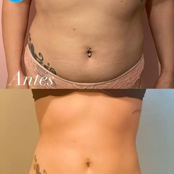 Be Healthy SPA - Antes y después , clienta con paquete de 8 sesiones de masaje reductivo - Physical Therapy Near Me