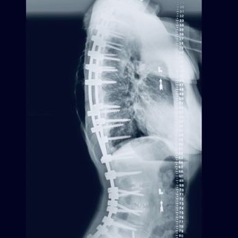 UCSF Spine Center - Post-op X-ray - Orthopedists Near Me - San Francisco, California UCSF Spine Center - Post-op X-ray - Orthopedists Near Me - San Francisco, California