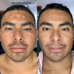 The Skin Whisperer - Cystic acne feels horrible. Let me help you get rid of it once and for all!