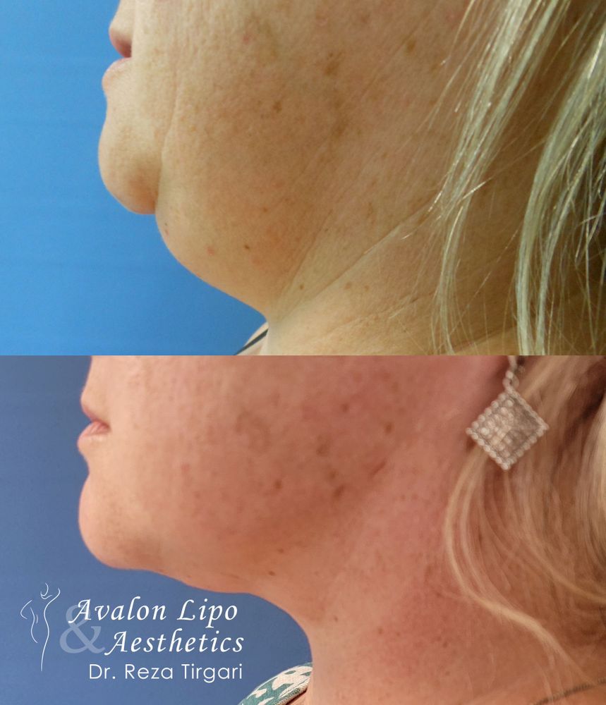 AVALON LIPO & AESTHETICS Updated October 2024 107 Photos & 44