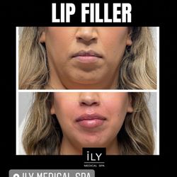 Ily Medical Spa - Lip Filler. Dermal Filler Juvederm, Versa, Restylane.