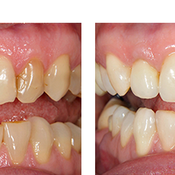Dove Family Dentistry - Bartlett - Crowns