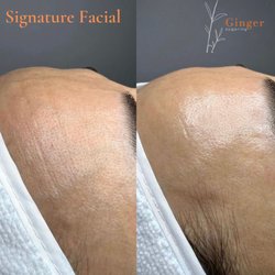 Ginger Sugaring - Ginger Studio Signature Facial performed by Nadia. Look how amazing the difference