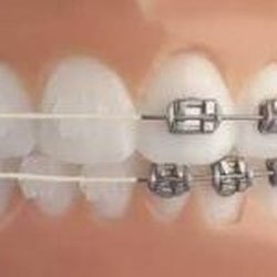 Aliso Niguel Dental Group - Yes, braces can look this good. We do them!