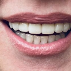 Lynnwood Dental Excellence - Vaneers