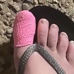 Michael Golf, DPM - Post surgery