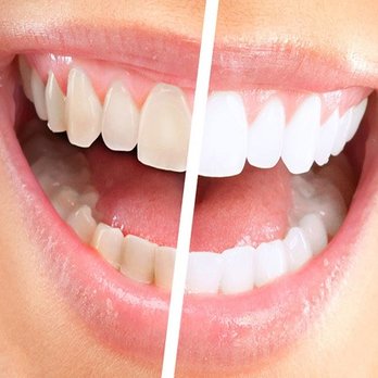 Savon Dental House - Before and After Whitening - General Dentistry Near Me - Phoenix, Arizona Savon Dental House - Before and After Whitening - General Dentistry Near Me - Phoenix, Arizona