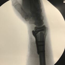 Jason H Tam, MD - Side view. What's a few screws through your bone amongst friends?