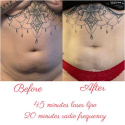Hair By Megan - 45 minutes of laser lipolysis and 20 minutes of radio frequency treatment