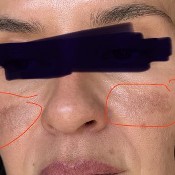Jovem Medspa - Dark patches from the high laser settings - Medical Spas Near Me - San Antonio, Texas Jovem Medspa - Dark patches from the high laser settings - Medical Spas Near Me - San Antonio, Texas