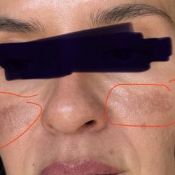 Dark patches from the high laser settings