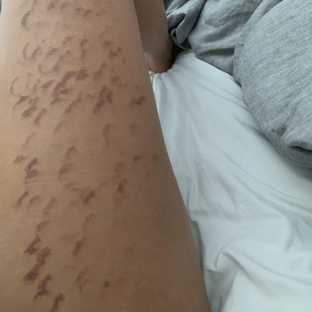 Ideal Image Tampa - Day after treatment. - Laser Hair Removal Near Me - Tampa, Florida