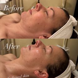 Skin Rejuvenation - Before and after custom facial