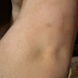 SKC Dermatology - After 5 days of treatment by his pediatrician