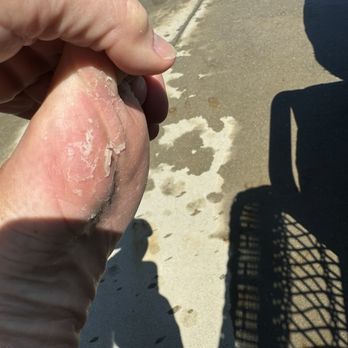 Clover Nail Spa - Idk what or why my foot was inflamed and peeling - Nail Salons Near Me - Virginia Beach, Virginia